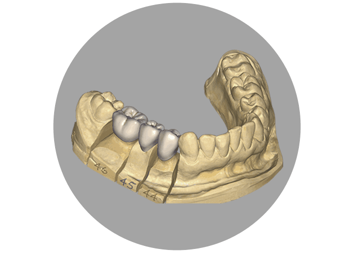 Polymer Crowns Protect Bone from Stress